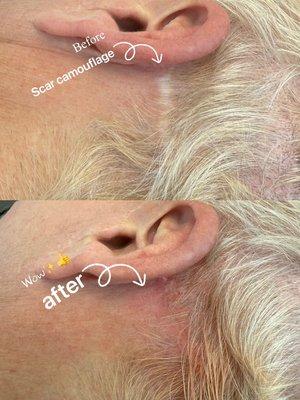 Scar camouflage tattoo