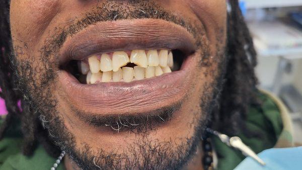 This gentleman recently visited our dental office here in Great Neck. He originally broke his front tooth as a child, tried to repair it, a