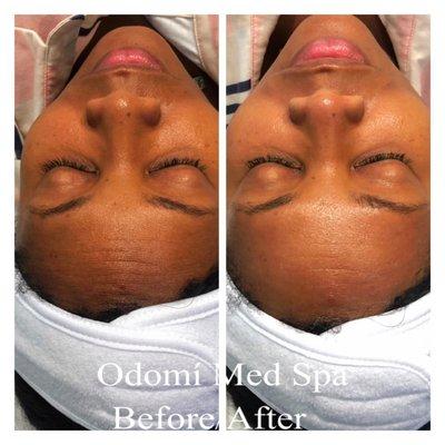Hydra facial treatment