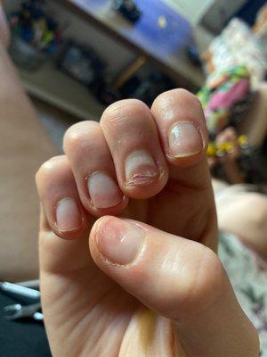Nail Problems