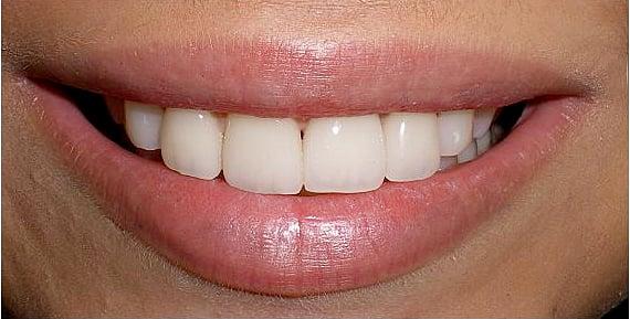 Implant Crowns before and after installation showing the underlying anchor mechanism and then covered by the beautiful new tooth