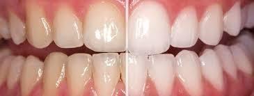 Custom take home bleach trays created to fit your teeth. 14 days and you too can have the bright white smile you have always...
