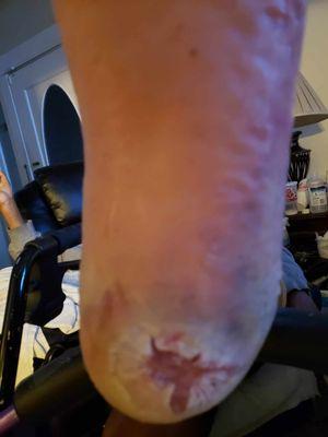 Open wond foot ulser.