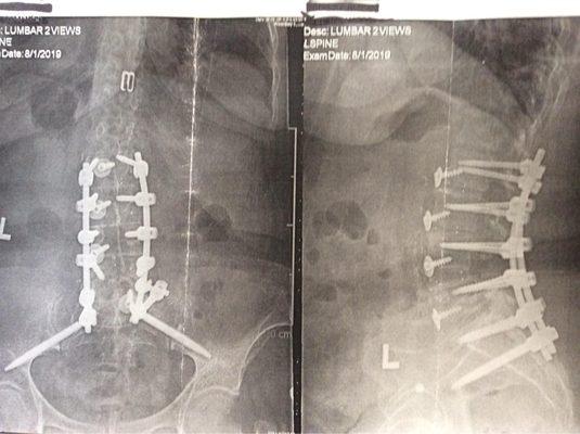 My spinal fusion.