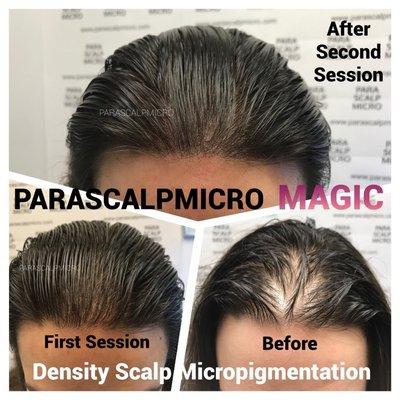 Magically fix Female Pattern Baldness, Hair Density Scalp Micropigmentation, Nano Hair Follicle Tattoo.New York City Best Artist training