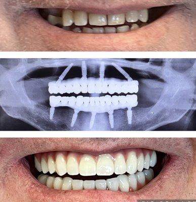 Modesto Dentistry And Implants