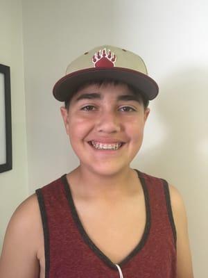 Braces are off!!! What a transformation! Thank you Dr. Minnich and staff!!!