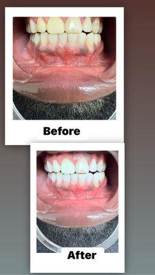 Before and after results