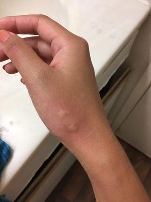 More bedbugs bites