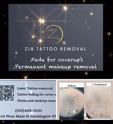 stuck with body art from your past consider laser tattoo