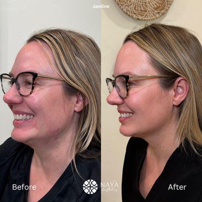 Jawline Tox using Dysport