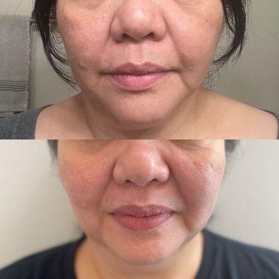 Top- after getting the Natural fillers and PRP Below- before the Natural fillers and PRP