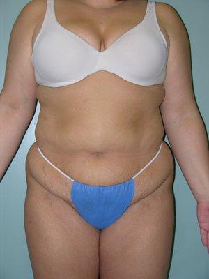 Abdominoplasty pre-op