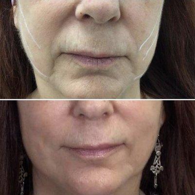 Before & After of pdo thread lift