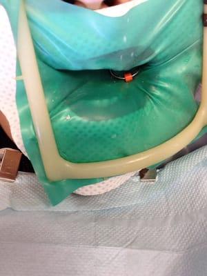 Painless!!! Thanks Dr. Cho!