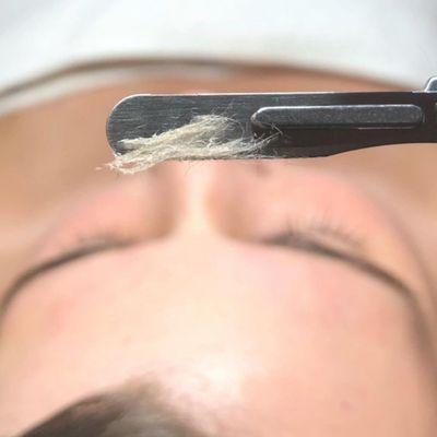 Dermaplaning is great to remove peach fuzz and dead skin cells.