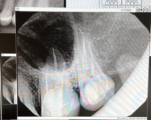All done. I think it is cool how you can see where they drilled down the root to kill the nerve. Shows up on an x-ray.