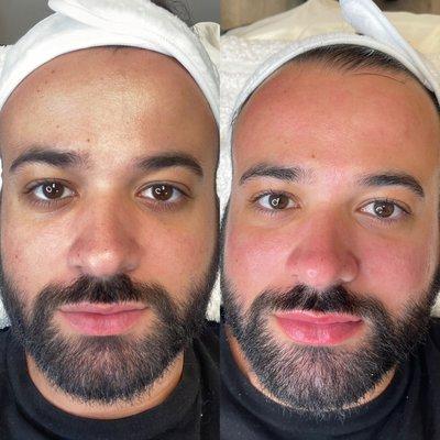 This facial included: Ultrasonic shovel knife, Extraction, Facial, and Microneedling for the face and lips.