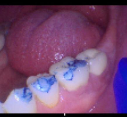 Short back new crown from Zak Dental. Dr Charles Chung. Photo courtesy of Zak Dental Ventura