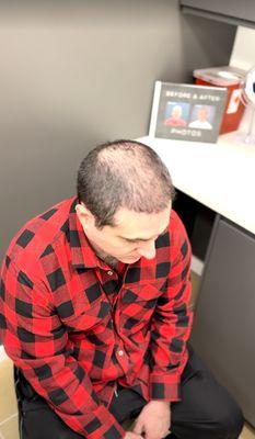 Nova Medical Hair Transplant