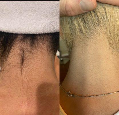 Laser hair removal results