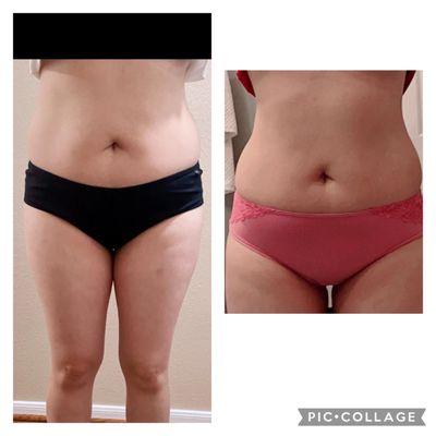 Before and after results of 4 lipo laser sessions with cavitation and radio frequency