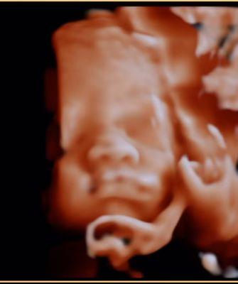 Experience the joy of seeing your little one in stunning detail with our 3D/4D OB ultrasounds - a beautiful glimpse of your baby before arri