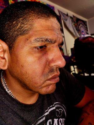 This is what happened when I was left in a house full of mites for 4 months... I'm tired of suffering  more because of other people...