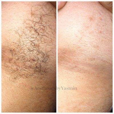 Before and after underarm