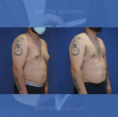 Gynecomastia surgery 1 month post-op