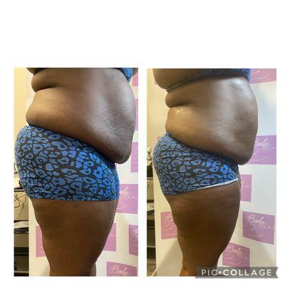 Lipo Cavitation before and after results. Melts away fat cells in problematic areas.