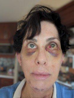 one week after surgery: hematoma in left eye