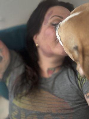 Facial cupping for tmj pain is glorious