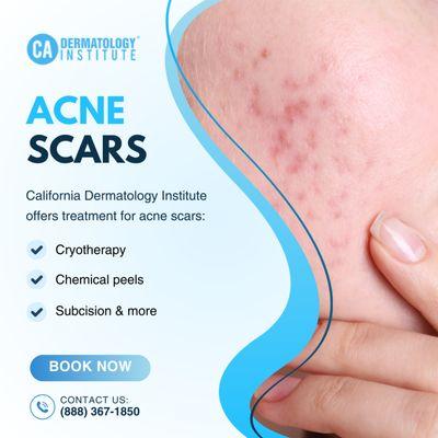 Effective Treatments for Acne and Acne Scars