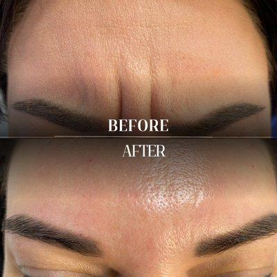 Botox : Before and after