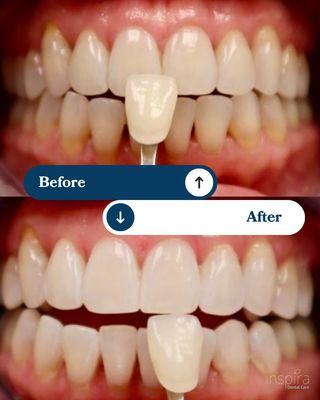 Zoom teeth whitening