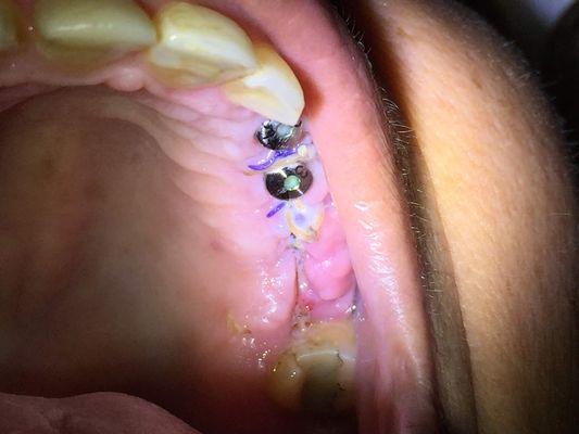 Dental Implants Costa Rica