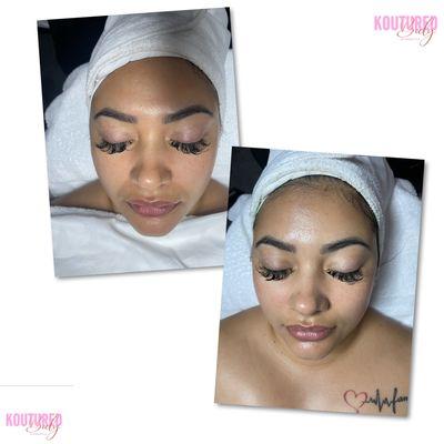 Iontophoresis Facial Treatment