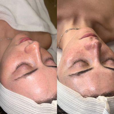 Before and after a facial