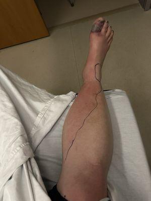 The line shows how far the infection went up his leg, less than 48 hours after receiving a pedicure at ABC Nails