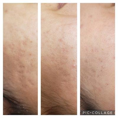 Cosmetic Microneedling