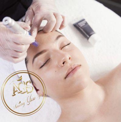 Microneedling Treatment with Hyaluronic Acid!
This treatment can improve the look and feel of your skin, improving your overall appearance