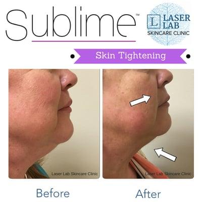 No pain. No scalpel. Now downtime!