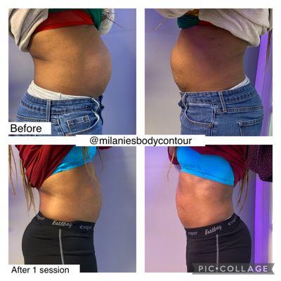 Milanies Body Contouring