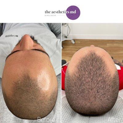 PRP Hair Restoration