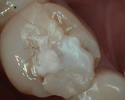 Uneven filling of my molar