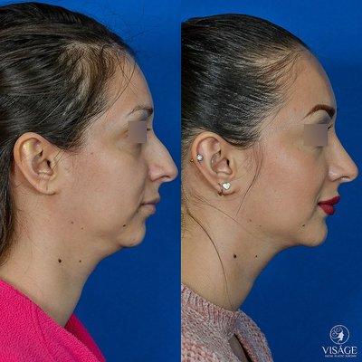 Before/after rhinoplasty + chin implant