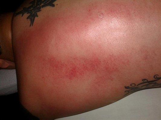 Cupping Therapy (after)