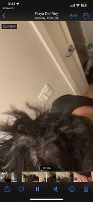 First stages of centrifugal alopecia ( permanent baldness) caused by improper relaxer application.