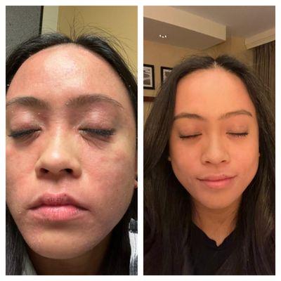 Skin Rejuvenation at Renew Medical. Results in less than 24 hours.